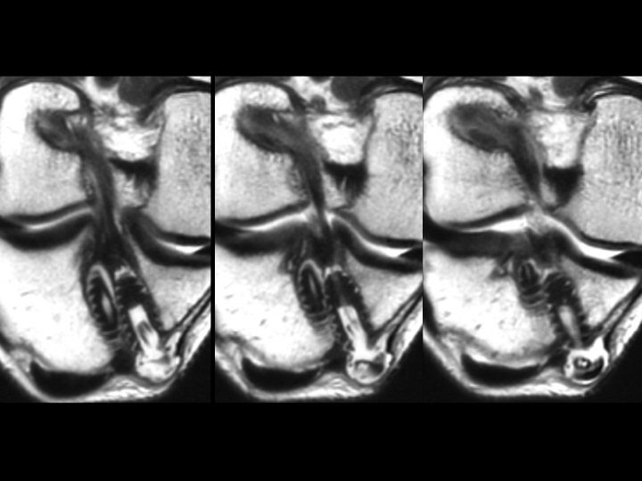 Figure 2 for case ACL graft device ( RID5523 )